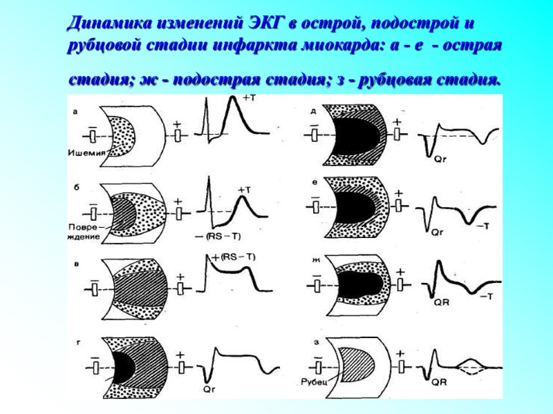 Динамика изменений ЭКГ в острой, подострой и рубцовой стадии инфаркта миокарда: а - е